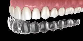 Ορθοδοντική με Διαφανείς Νάρθηκες (Invisalign):